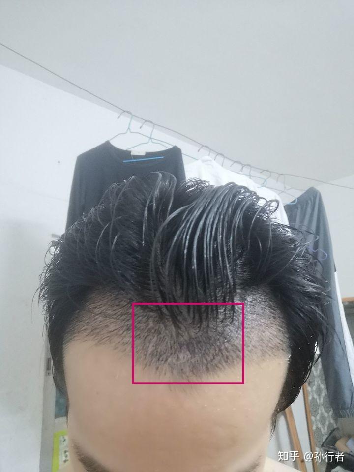怎样才是正常的发际线 v2-55b3db7ee9aa3453b6315792ec099a12_r.jpg