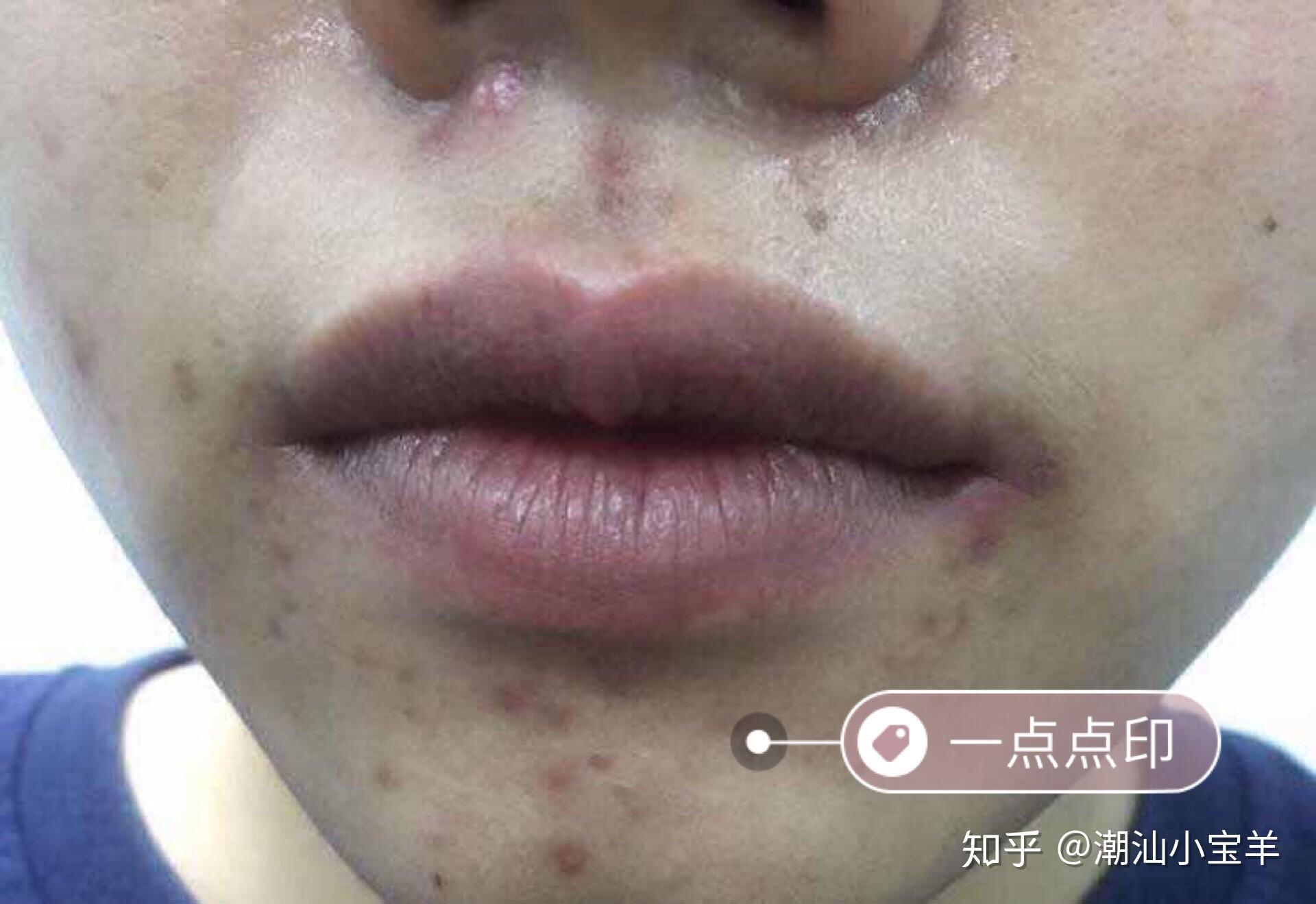 与痘痘抗争的日子