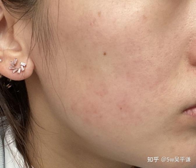 油性敏感肌肤适合什么护肤品