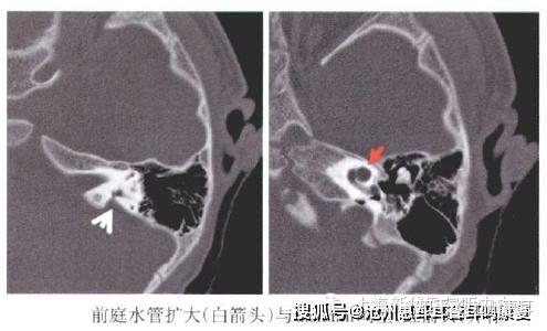 前庭水管解剖 – 側頭骨ct 解剖図 – NSTIXA