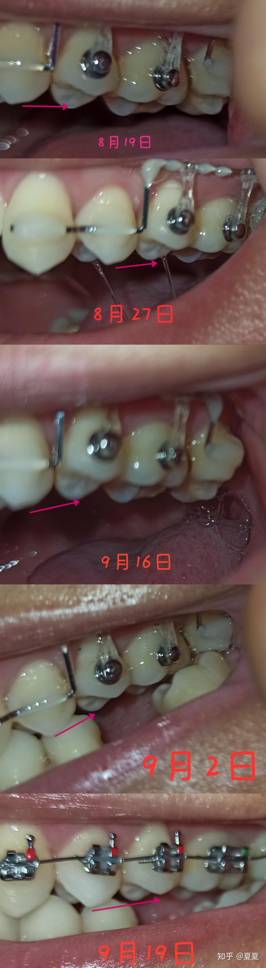 71158月15日(片段弓压低伸长牙齿)