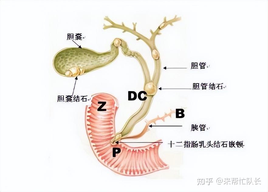 胆管在哪里？急性胆管炎和慢性胆管炎有什么区别？ 知乎