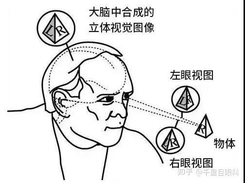 形觉剥夺性近视