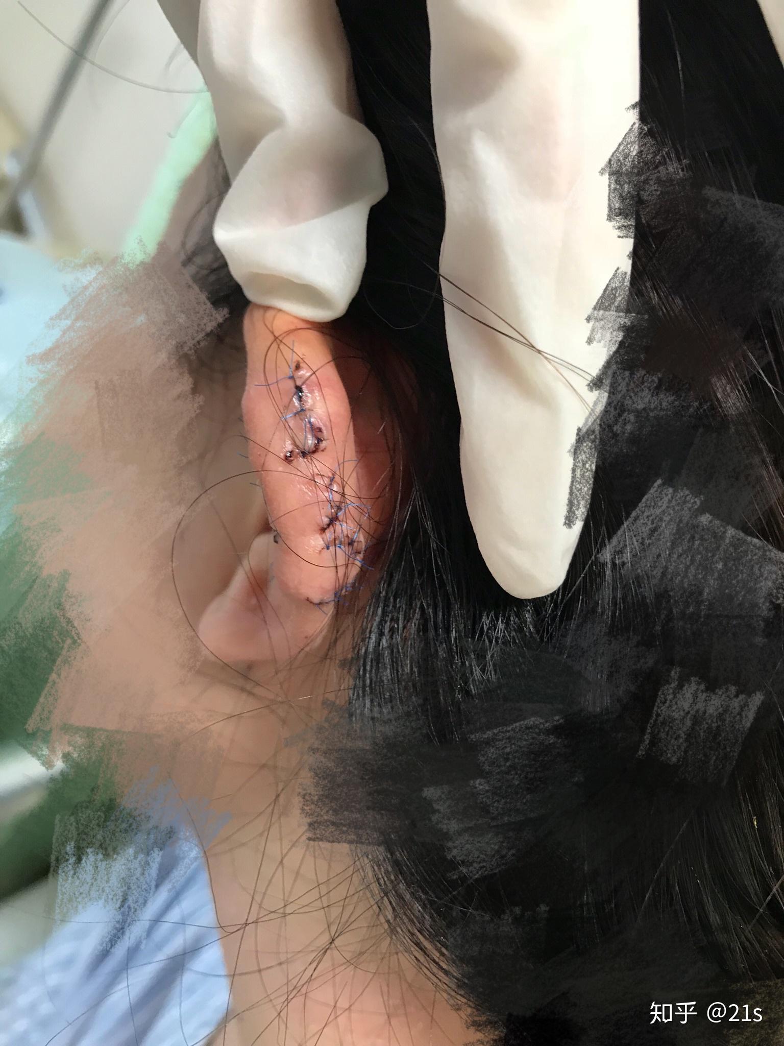 耳部瘢痕疙瘩治疗记录