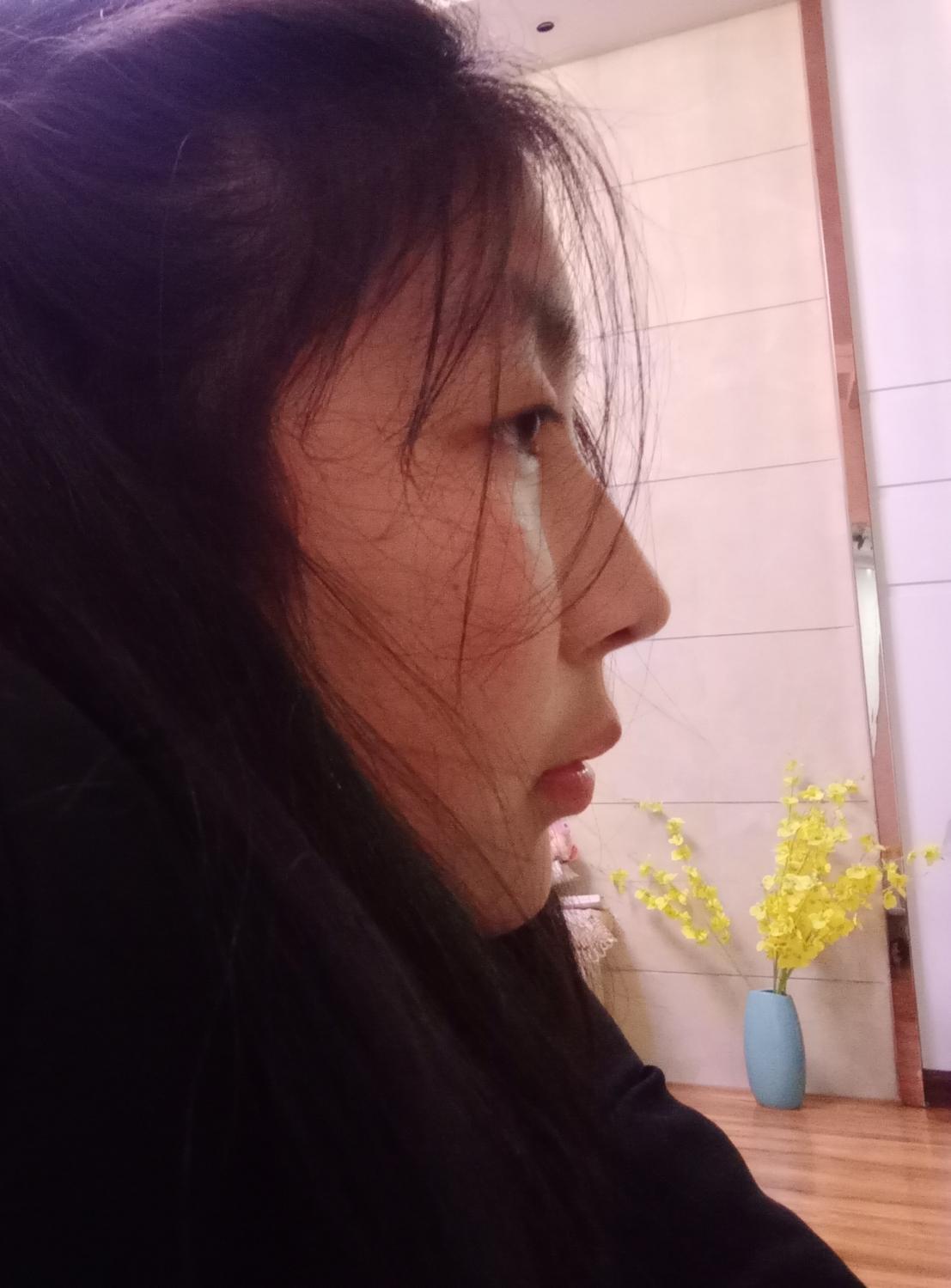 侧面看眼睛非常突眉骨低和鼻子连接不起来是怎么回事