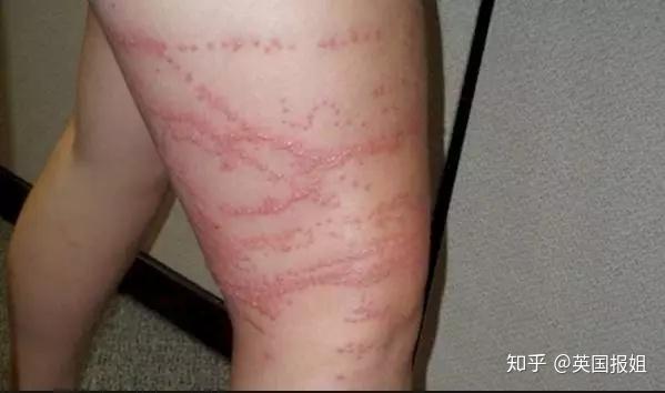 虽然有不少朋友早已知晓僧帽水母的危险性.