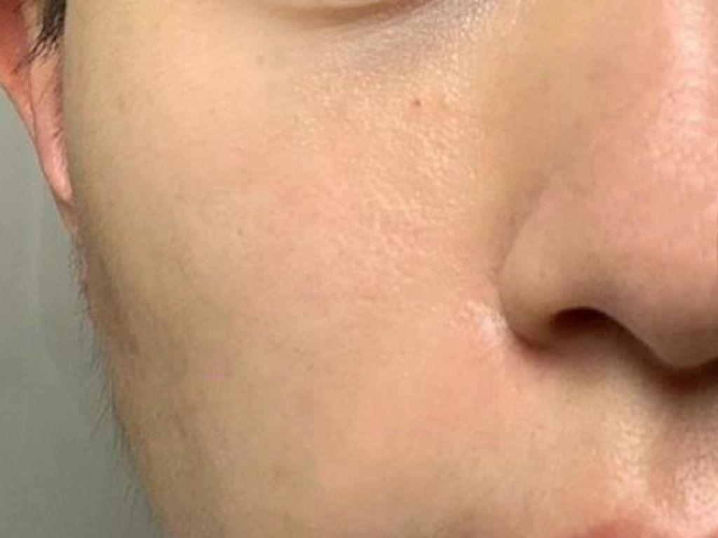 脸部皮肤毛孔粗大如何改善?