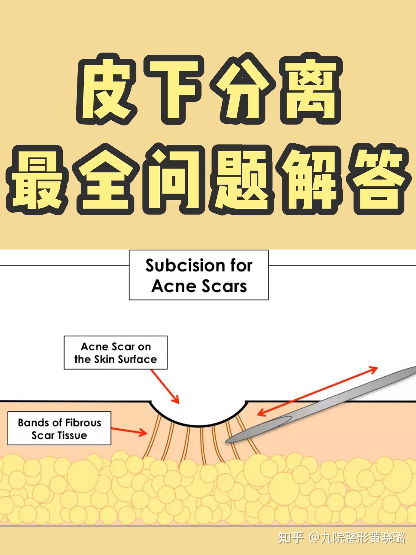 皮下分离常见问题解答 - 知乎