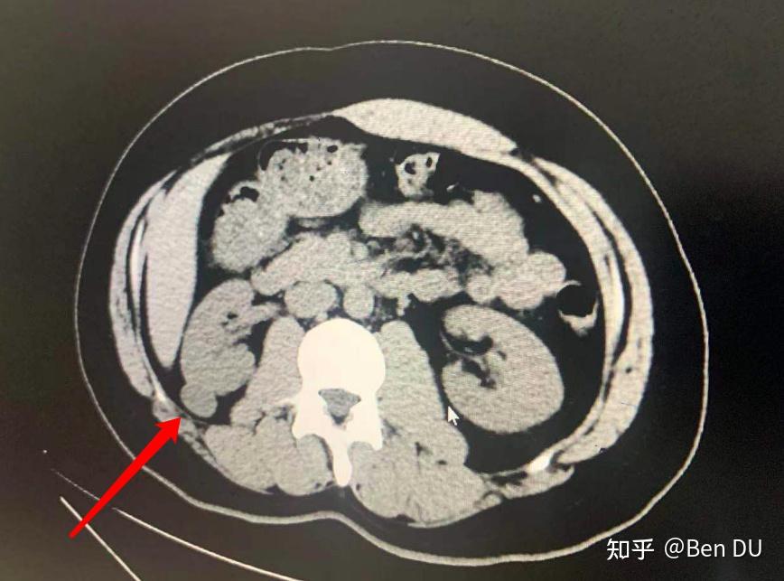 从肋膜炎的一次病情中想到