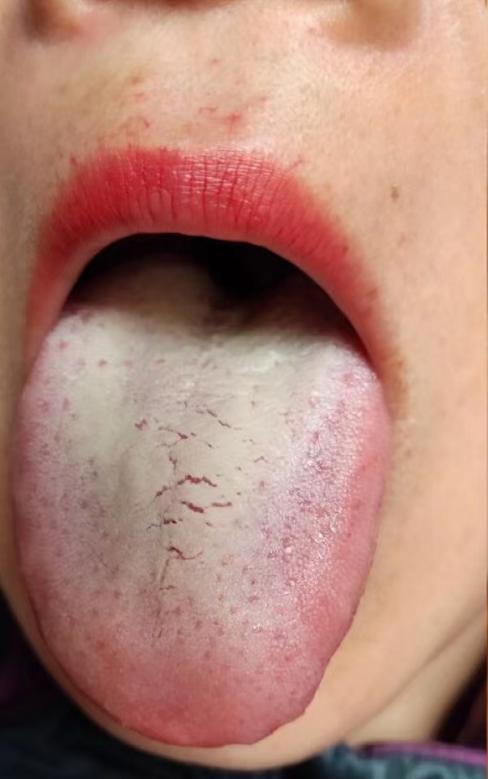 便宜!舌苔厚白最快消除方法"孕期反应"-第1张图片-宝林网