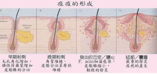丘疹型痘痘要多久才能自愈? - 知乎