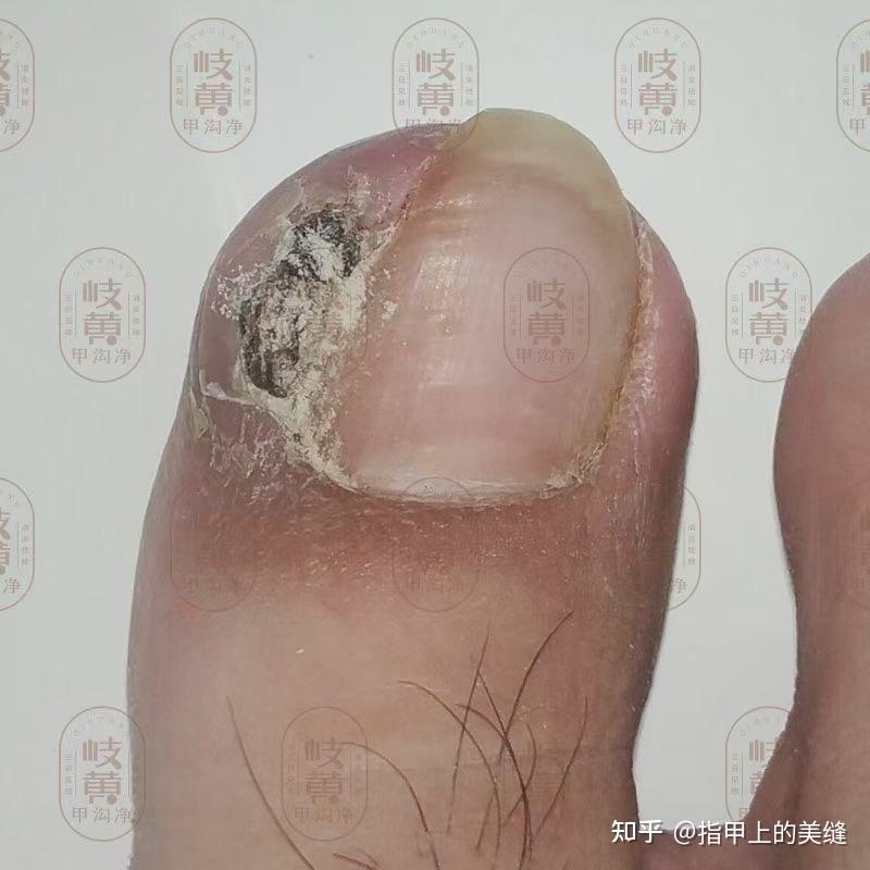 脚趾甲沟炎长肉芽怎么处理不修脚可以治好吗