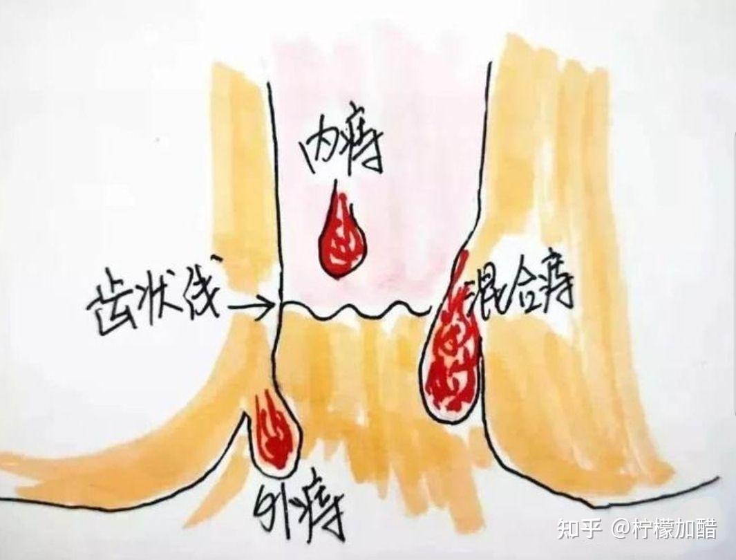 外痔出血 zhuanlan.zhihu.com