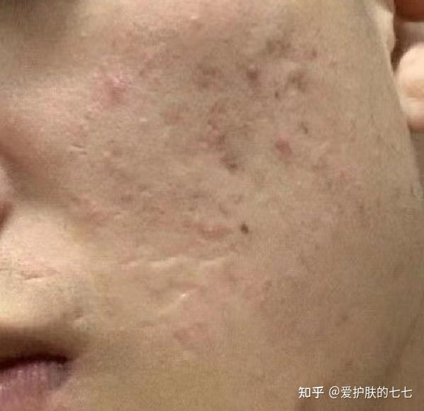 男生满脸痘印究竟怎样才能去掉?皮肤科医生教你科室专用去痘印方法,一个月把痘印去干净!4步搞定! - 知乎