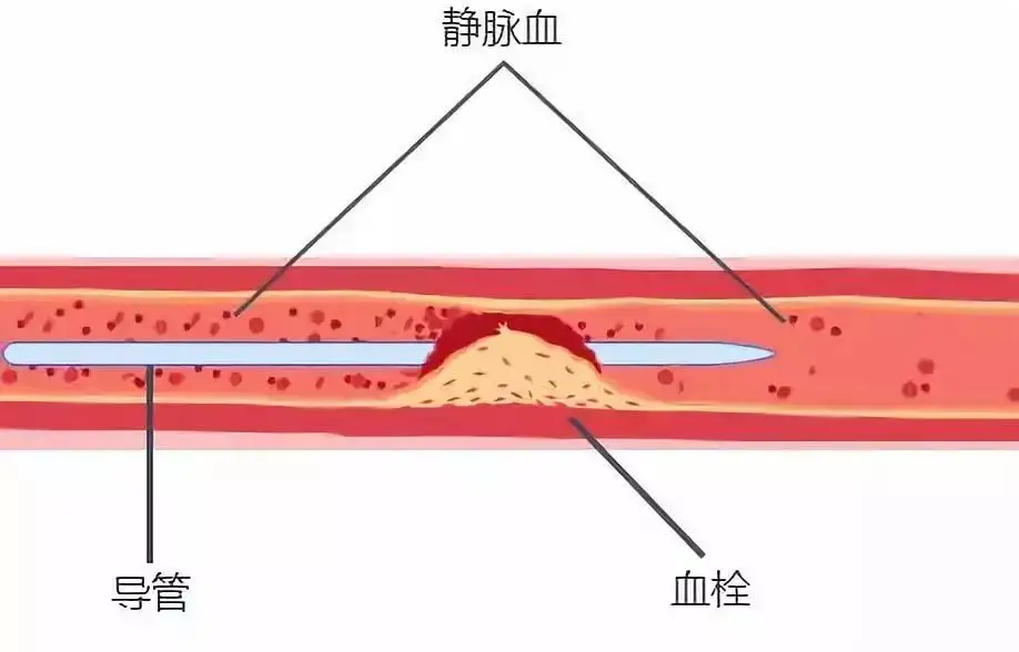 世界血栓日 - 知乎
