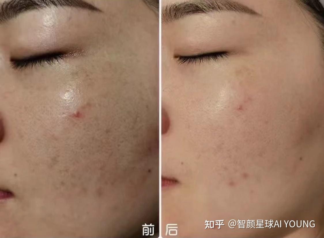 智颜小课堂平肤祛痘首选伊肤泉微针