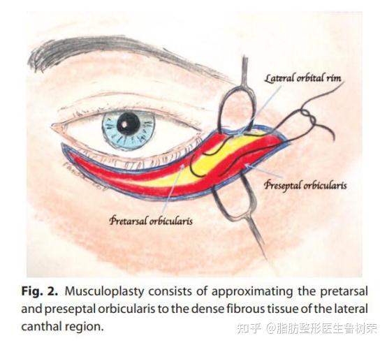 下眶缘对下眼睑的支撑力不足是传统外切眼袋并发症的主要根源