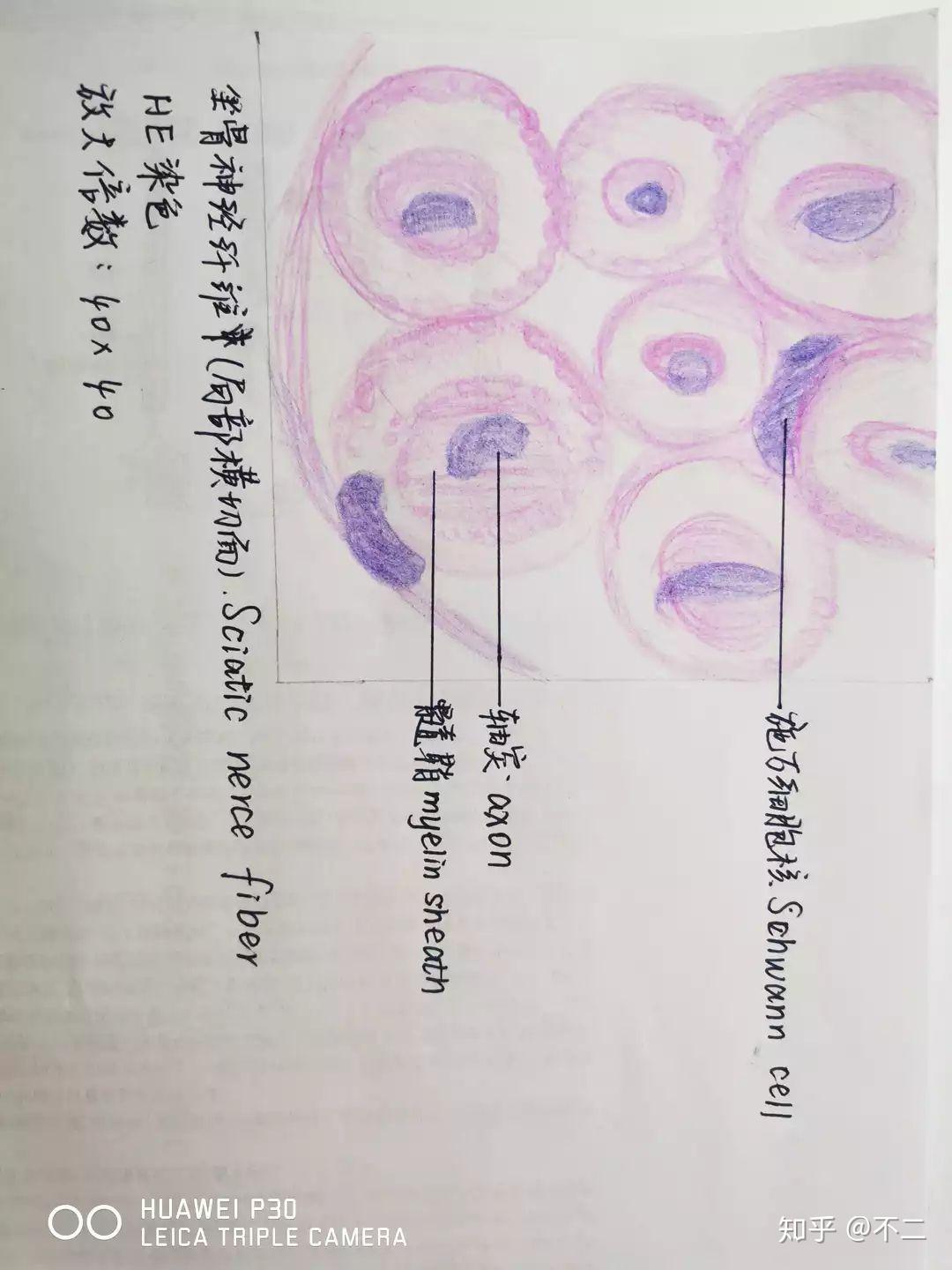 纤维瘤病理切片手绘图片