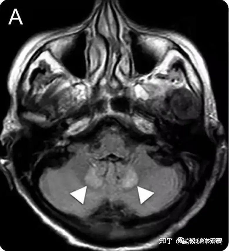 甲硝唑脑病是个啥