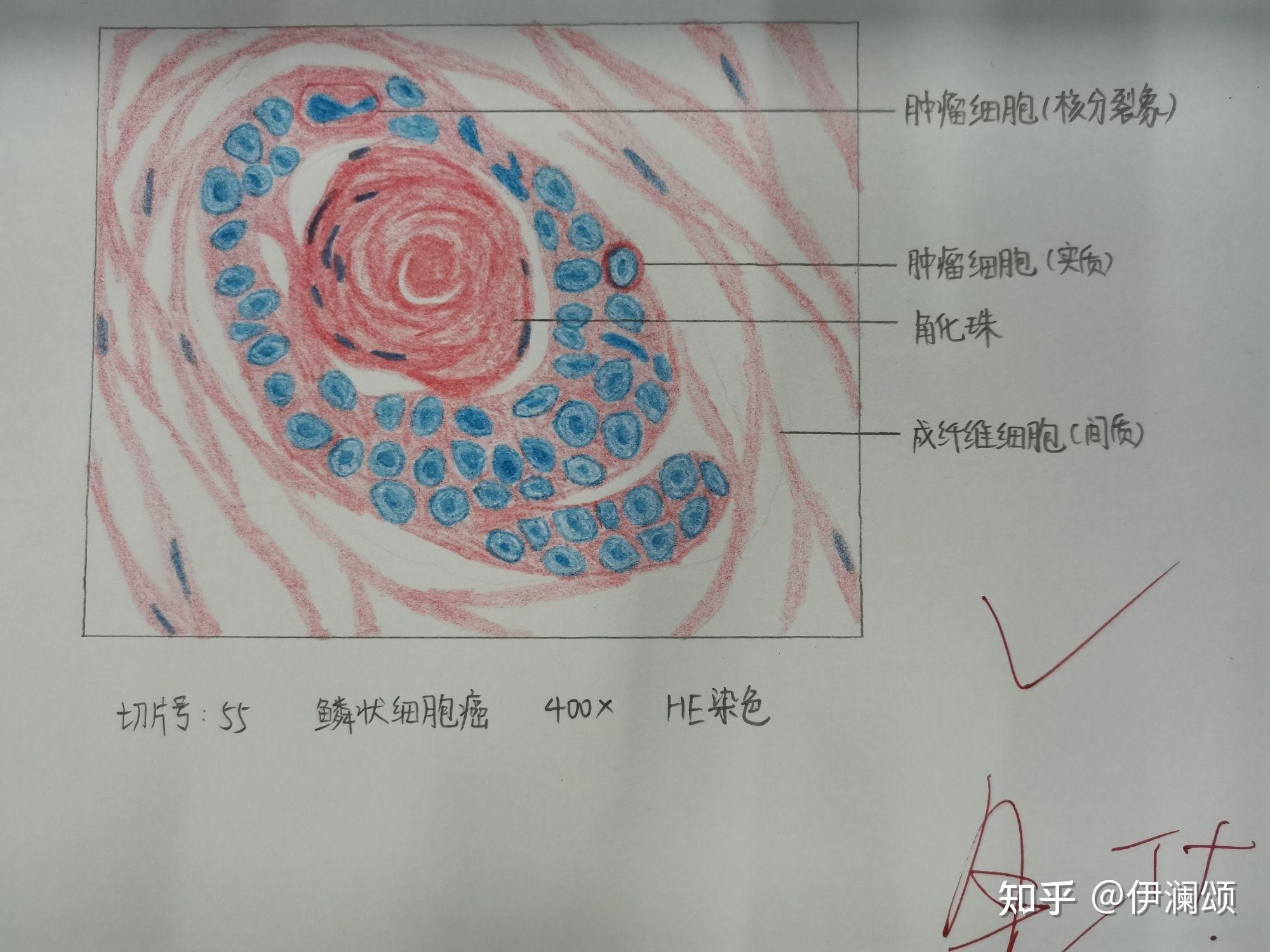 瘤巨细胞手绘图图片