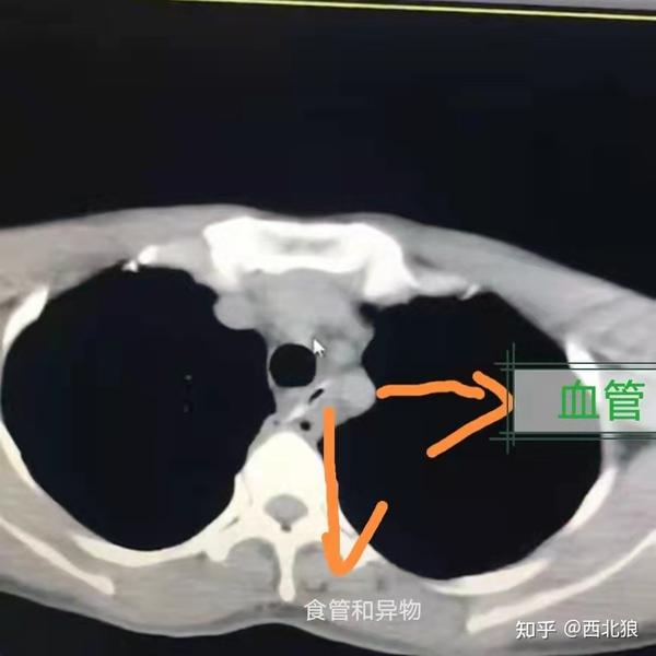 临床上曾经差点踩到的坑 - 知乎