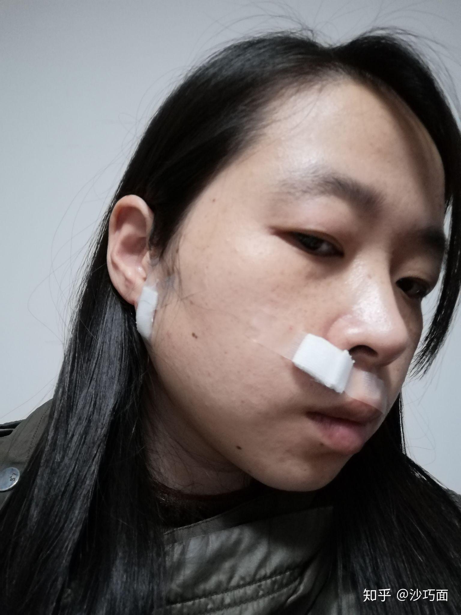 鼻侧手部去痣第一天