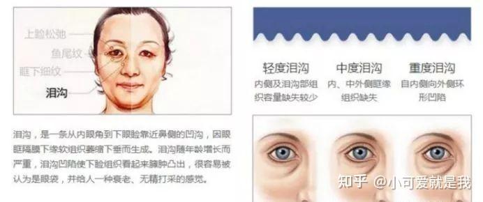 莫雅晴解读:怎么解决泪沟问题? - 知乎