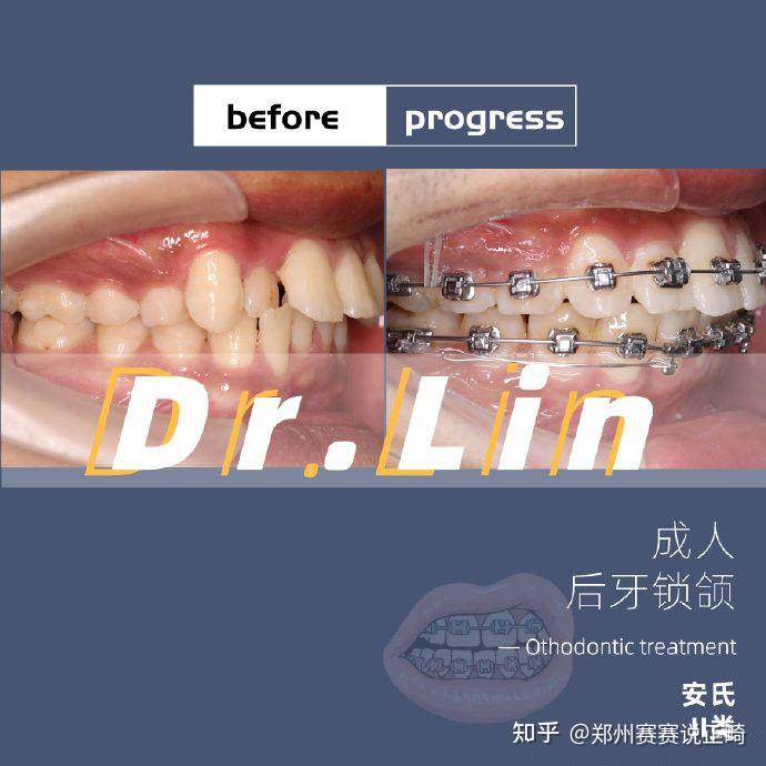 郑州牙齿矫正林范|案例名称:成人后牙锁颌 - 知乎