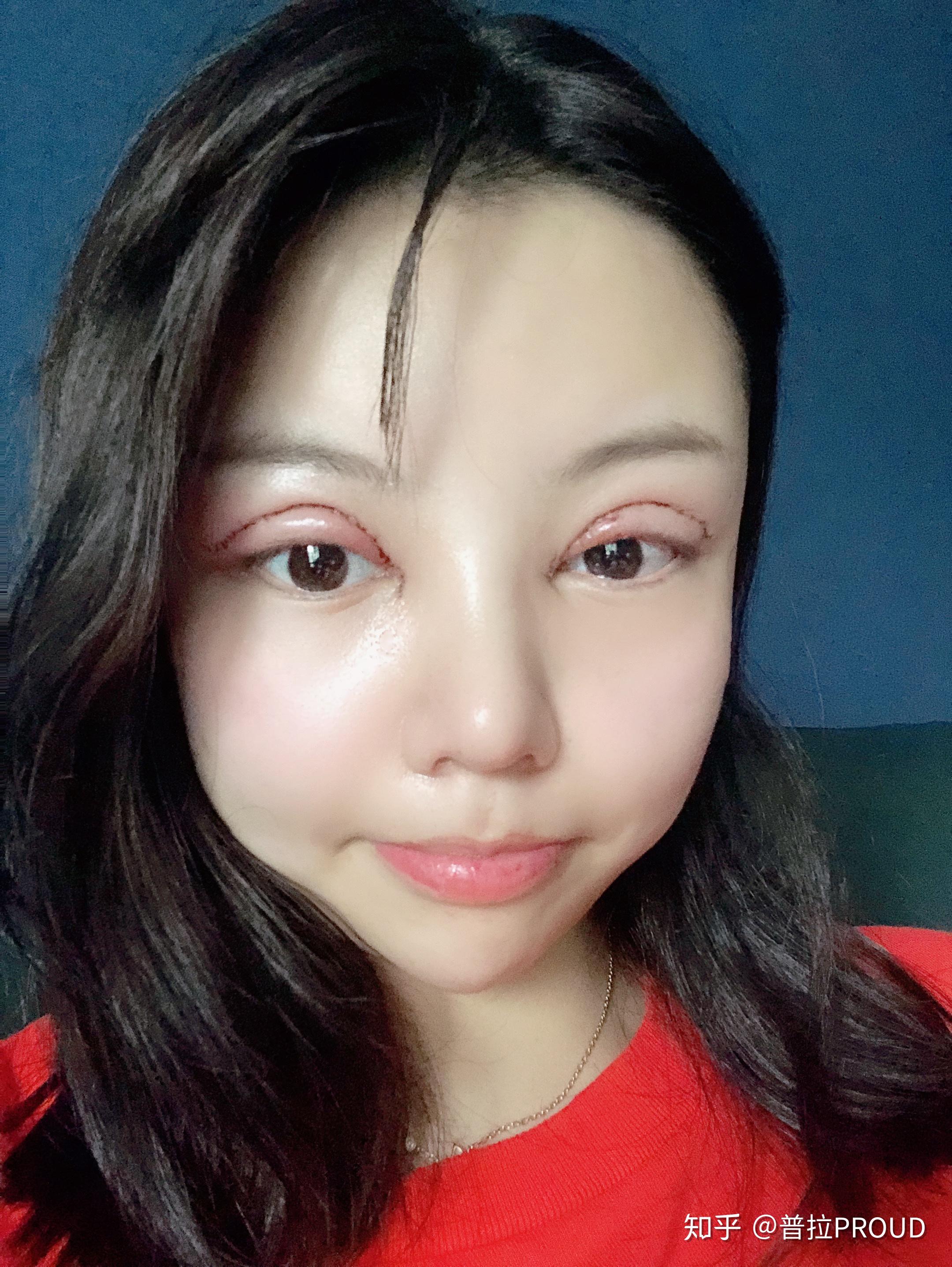 再见肿泡眼普拉张尚风让我拥有漂亮明眸