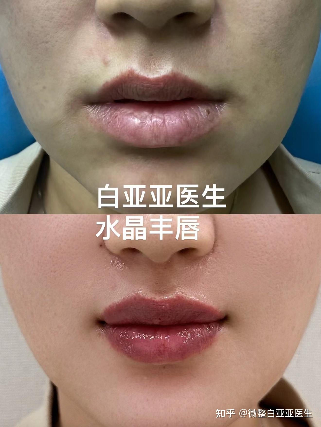 唇形与玻尿酸丰唇 - 知乎