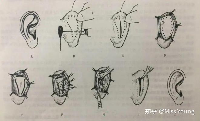 “精灵耳”火出圈!耳朵究竟对面部有什么影响? - 知乎