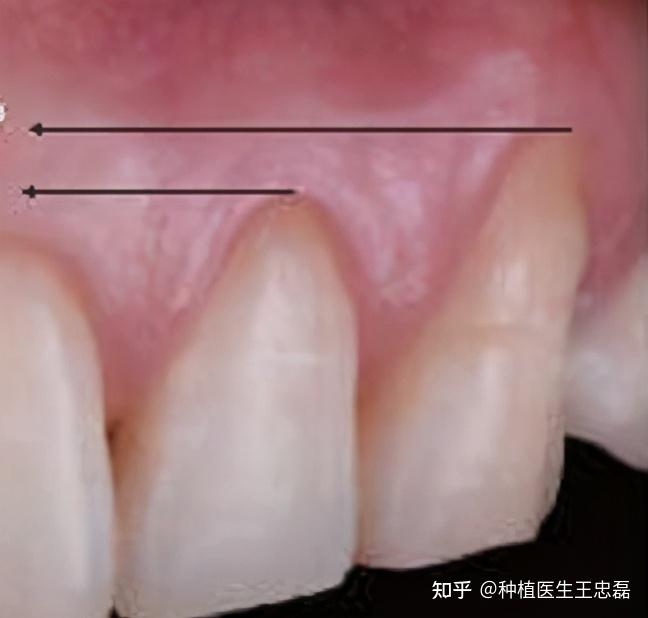 下牙床在哪里图片图片