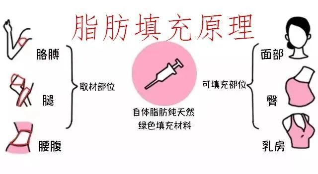 脂肪也能变废为宝什么是脂肪填充一步变瘦的脂肪填充原理是什么