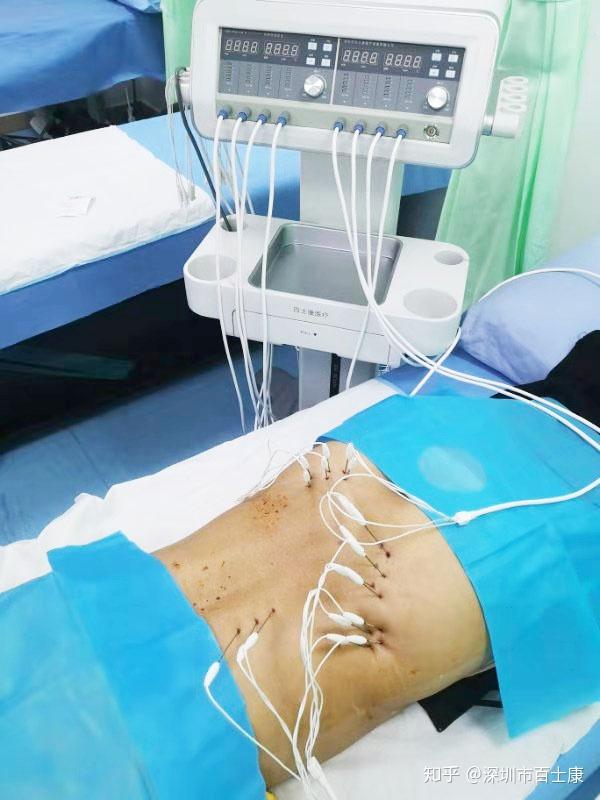 筋膜内热针疗法