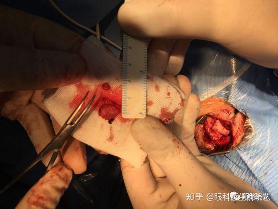 大力支持下,在主刀刘求红医师的细致操作下,一个半小时即顺利完成手术