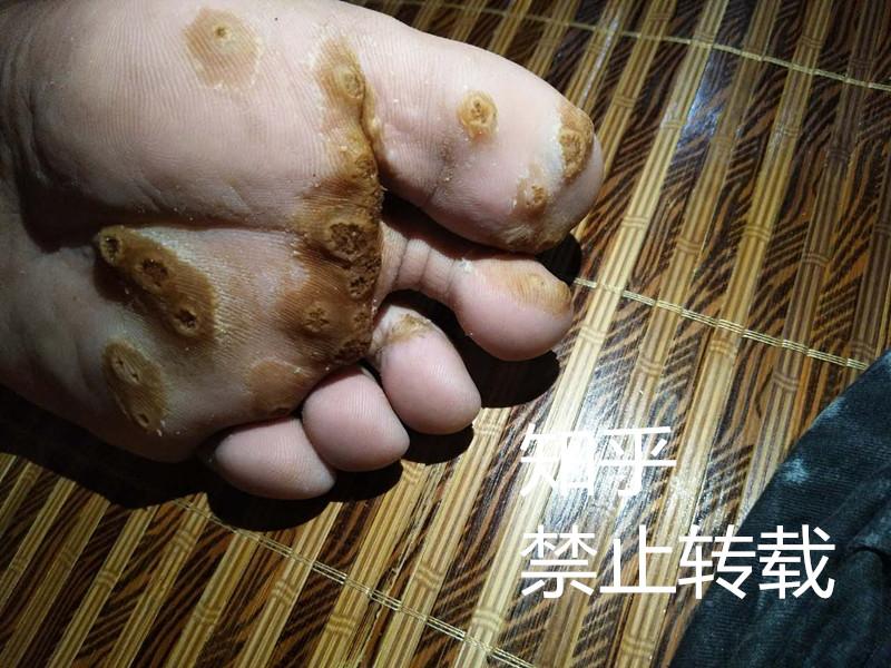 跖疣和鸡眼有什么区别,医学上有没有什么治疗