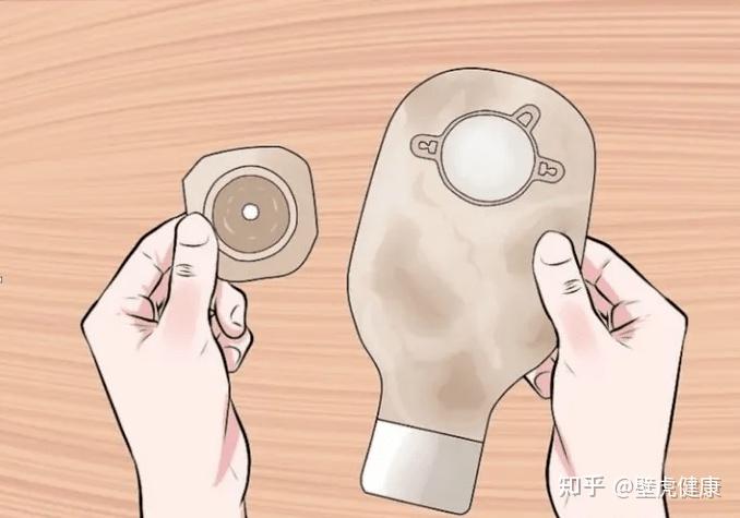格尔护士：造口人日常居家如何护理？这份“造口干货”好好收藏！ - 知乎
