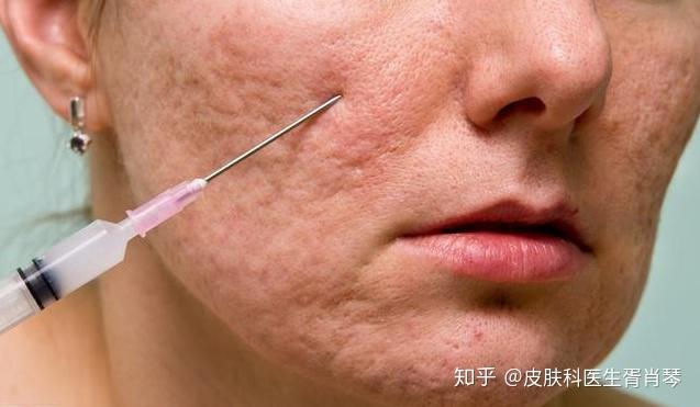 脸部疤痕修复疤痕路上的五大雷区:1,敞开伤口愈合更快常听说,皮肤有了