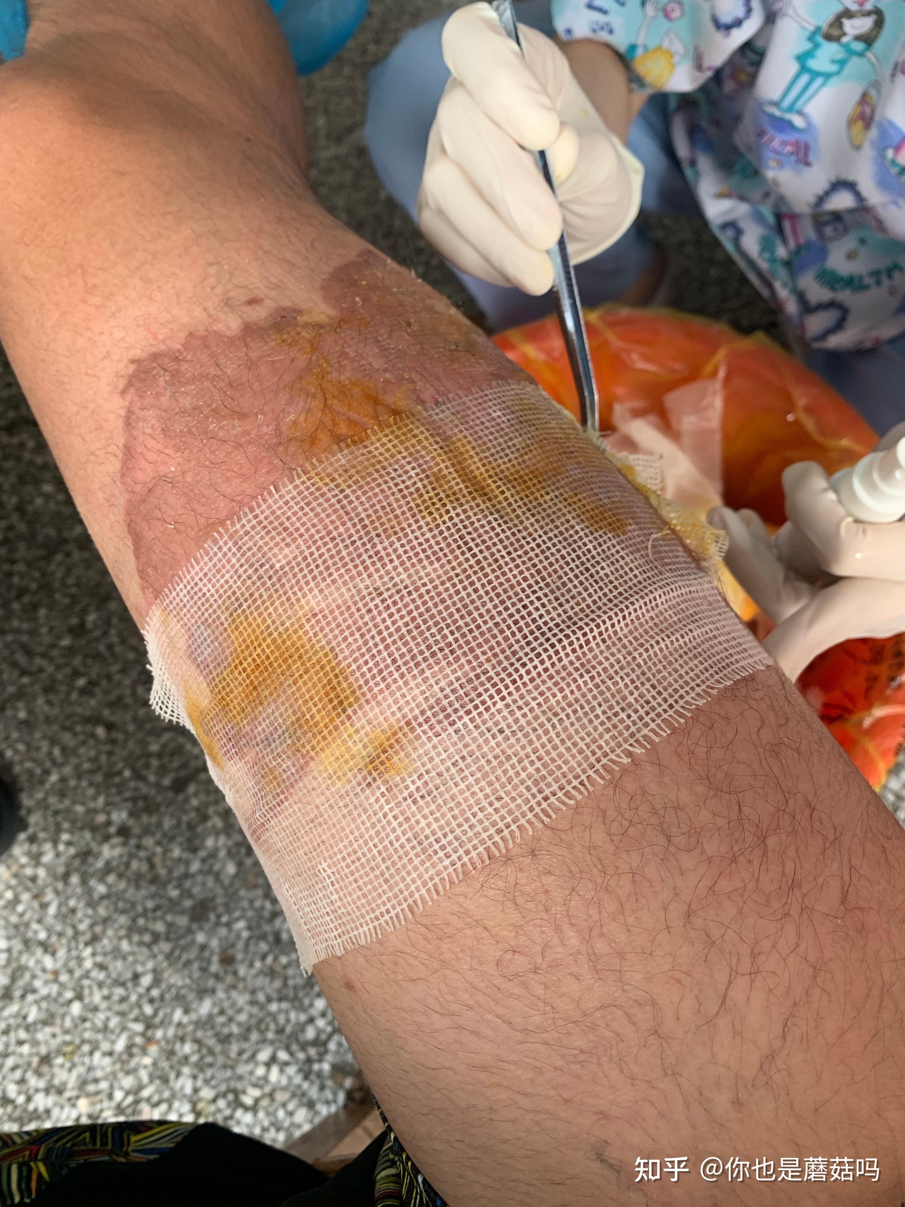 记录开水烫伤的恢复浅二级烧伤