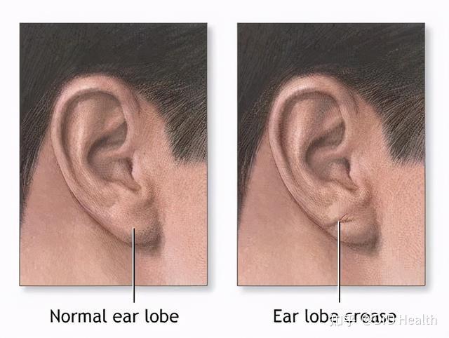 耳垂摺痕是怎麼回事?