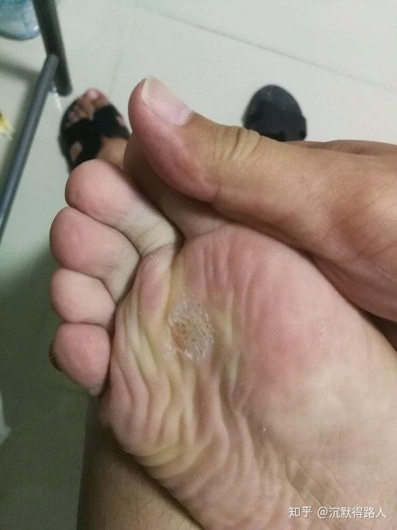 脚步扁平疣的治疗最省钱的办法亲测有效