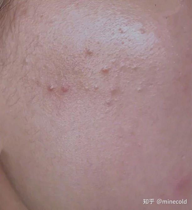 闭口的形成也跟第一种油脂粒--毛周角化有关毛孔周围的角质过度,堵塞