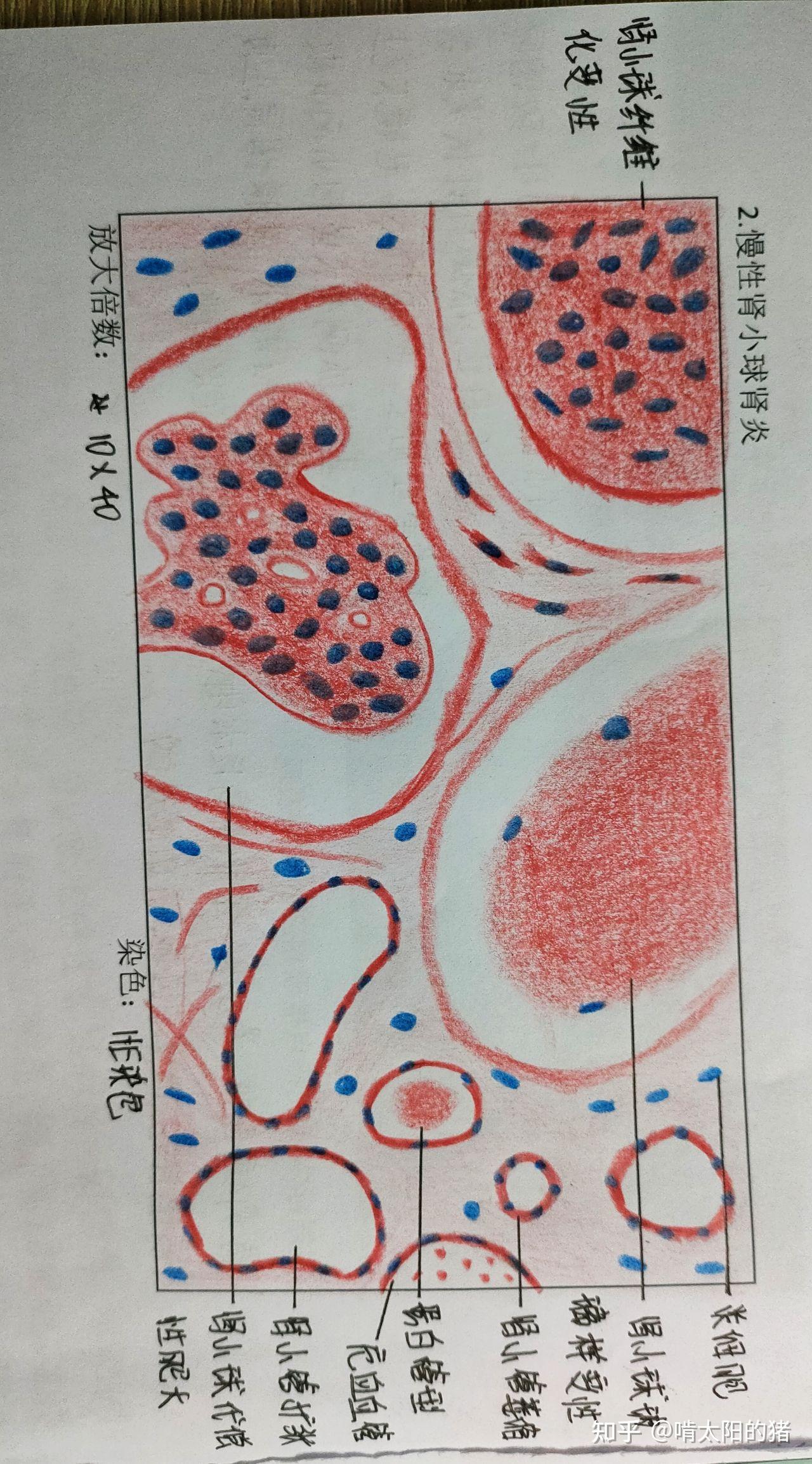 肝细胞坏死手绘图图片