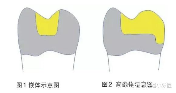 高嵌体预备制作示意图图片