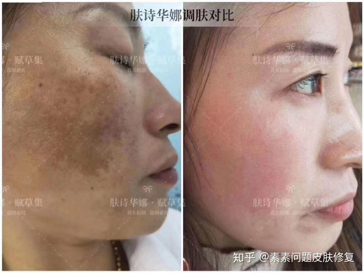 绿色海绵微针祛斑是什么原理.有效果吗?