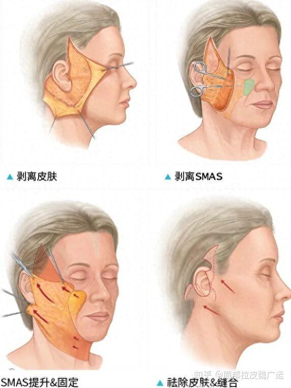 魏广运改良近位 SMAS 技术详解：第八代拉皮相比传统 SMAS 术式有哪些升级？ - 知乎