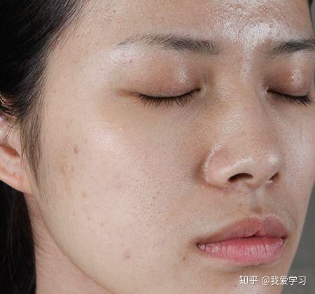 闭口克星:温和去闭口的正确方法 - 知乎