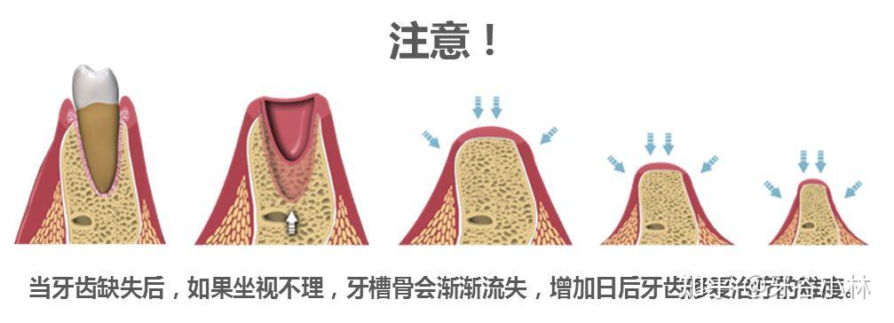 母親節送媽媽種植牙還她十年光陰