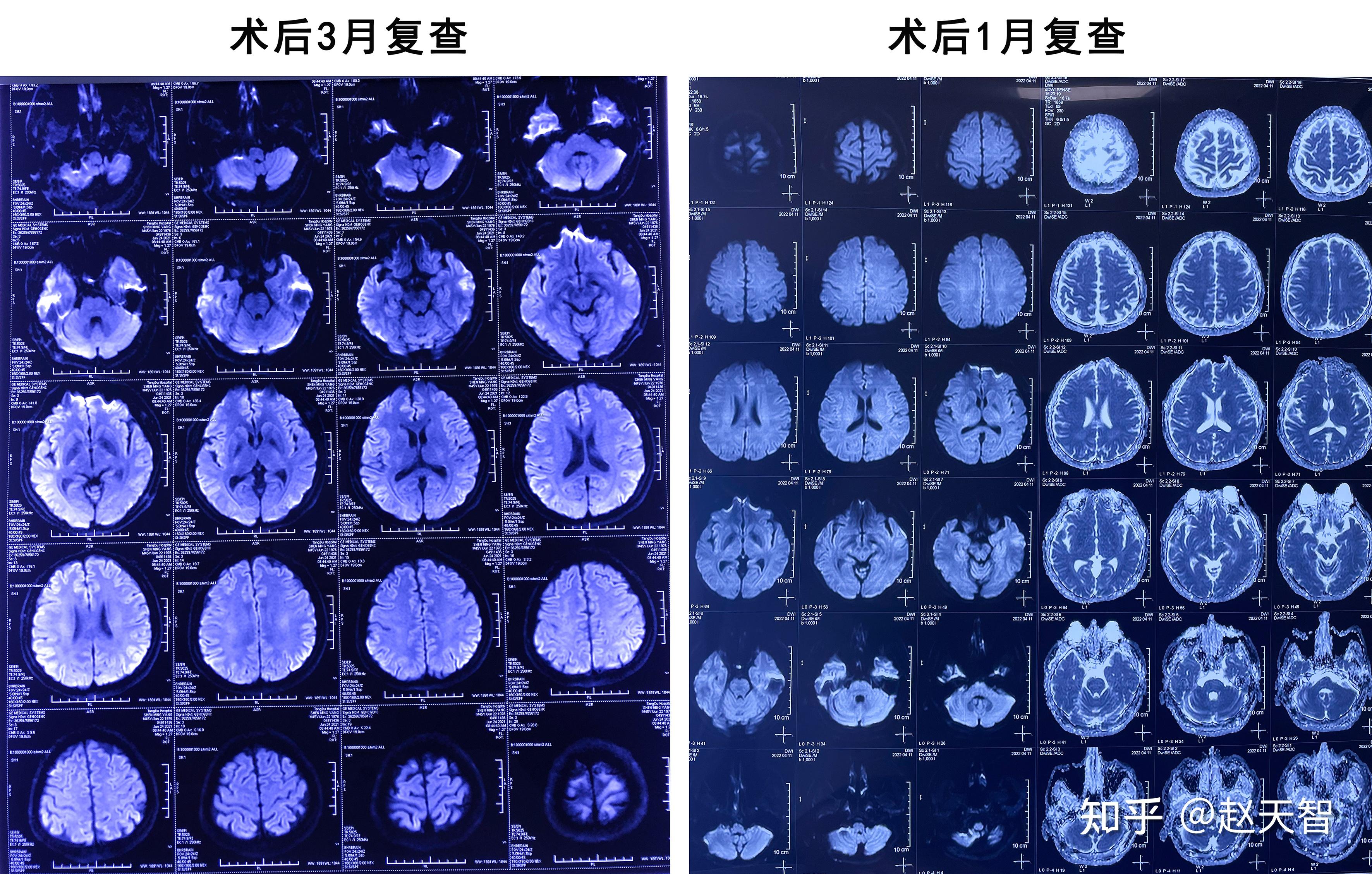 颅内胆脂瘤图片