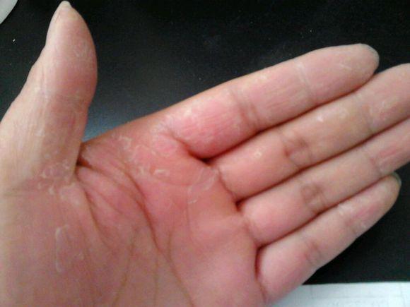 手脱皮是什么原因 知乎